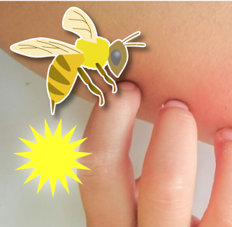 アナフィラキシーショック